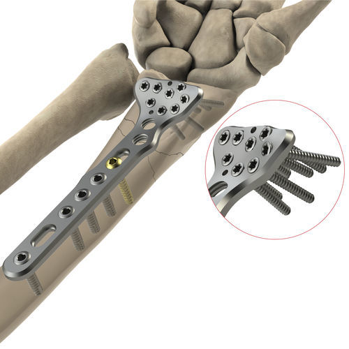 Placca di compressione per radio - DR Volar II - Ases Orthopedics - distale / palmare / bloccata