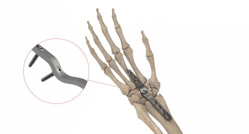 Placca di compressione carpale - HC Artrodesis LP - Ases Orthopedics - bloccata
