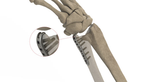 Placca di compressione per ulna - Styloid LP - Ases Orthopedics - bloccata