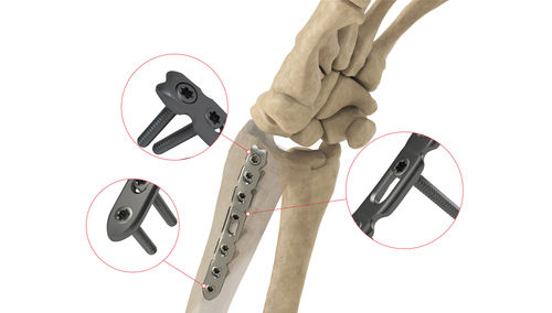 Placca di compressione per radio - DR Lateral LP - Ases Orthopedics - distale / laterale / bloccata