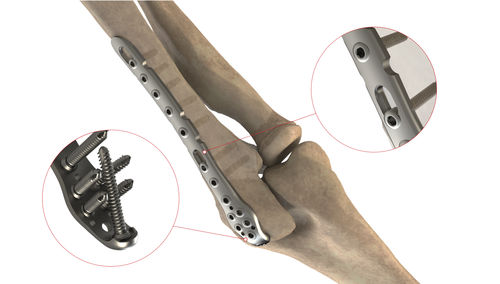 Placca di compressione per ulna - Ases Orthopedics - prossimale / bloccata