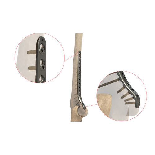Placca di compressione per omero - Ases Orthopedics - distale / mediale / bloccata
