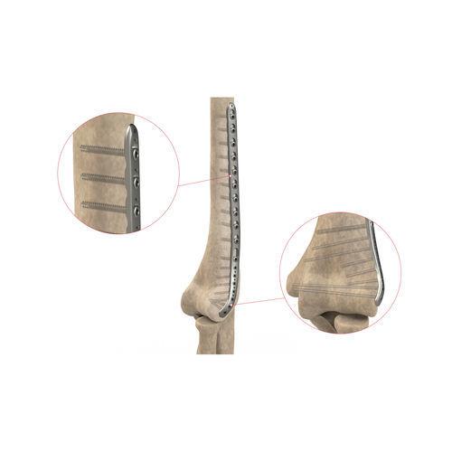 Placca di compressione per omero - Ases Orthopedics - distale / laterale / bloccata