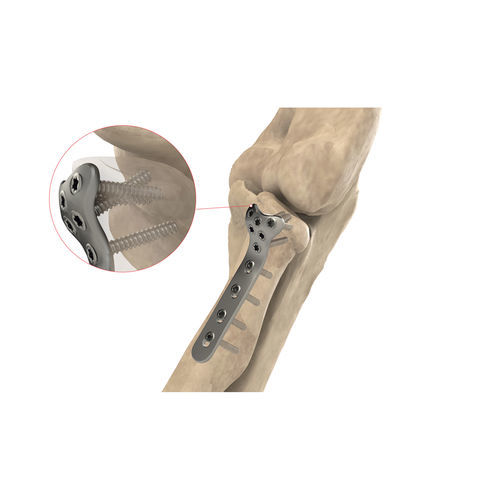 Placca di compressione per radio - Ases Orthopedics - bloccata