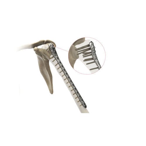 Placca di compressione per omero - Ases Orthopedics - prossimale / bloccata