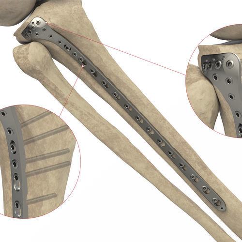 Placca di compressione per tibia - Ases Orthopedics - prossimale / laterale / bloccata