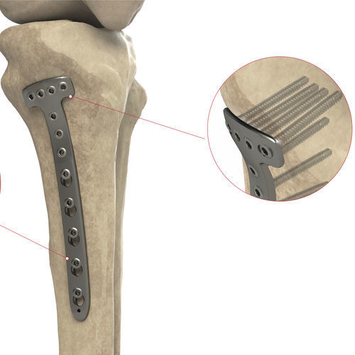 Placca di compressione per tibia - Ases Orthopedics - prossimale / mediale / bloccata