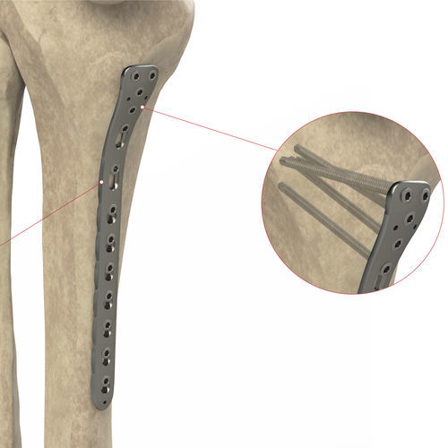 Placca di compressione per tibia - Ases Orthopedics - prossimale / mediale