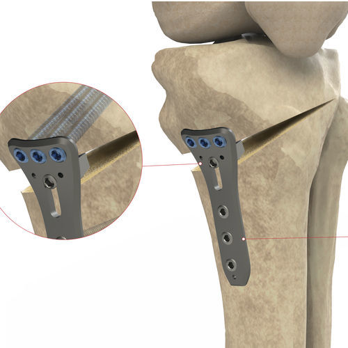 Placca di compressione per tibia - Ases Orthopedics - bloccata