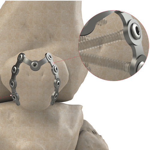 Placca di compressione per rotula - Ases Orthopedics - bloccata