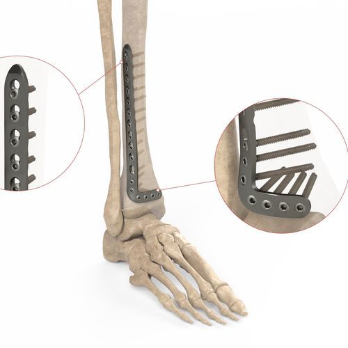 Placca di compressione per tibia - Ases Orthopedics - distale / anterolaterale / bloccata