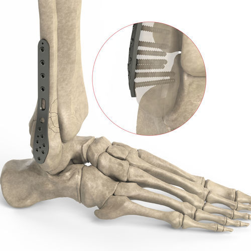 Placca di compressione per fibula - Ases Orthopedics - distale / laterale / bloccata