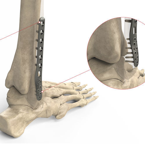 Placca di compressione per fibula - Ases Orthopedics - distale / laterale / bloccata