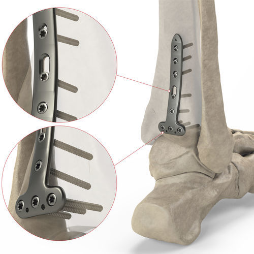 Placca di compressione per tibia - Ases Orthopedics - distale / bloccata