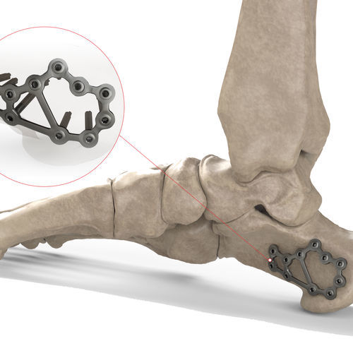 Placca di compressione per calcagno - Ases Orthopedics - bloccata