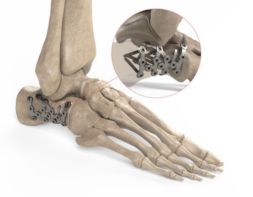 Placca di compressione per calcagno - Ases Orthopedics