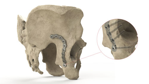 Placca di compressione per bacino - Ases Orthopedics - postero-prossimale