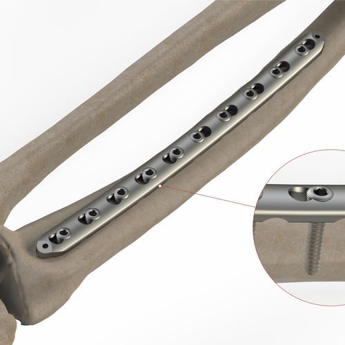 Placca di compressione per radio - 1T12 series - Ases Orthopedics - distale / bloccata