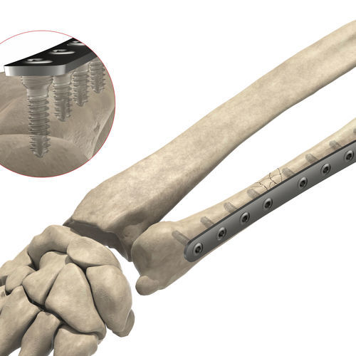 Placca di compressione per ulna - 1T12-06404 - Ases Orthopedics - distale / bloccata
