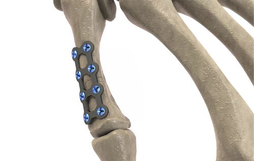 Placca di compressione per metacarpo - 1T112-10061506 - Ases Orthopedics - bloccata
