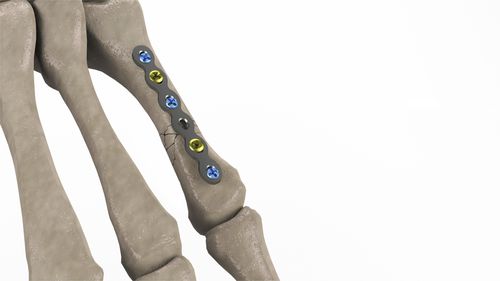 Placca di compressione per metacarpo - 1T112-10092006 - Ases Orthopedics - bloccata