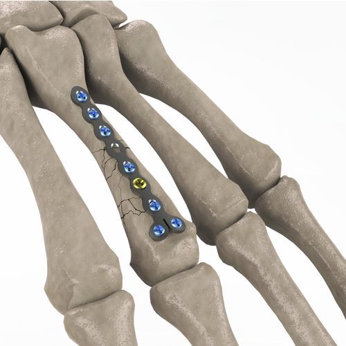 Placca di compressione per metacarpo - 1T112-100102023 - Ases Orthopedics - bloccata