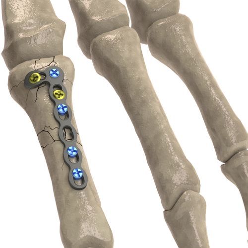 Placca di compressione per falange della mano - 1T112-100242705L - Ases Orthopedics - bloccata