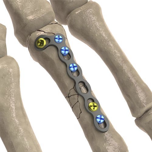 Placca di compressione per falange della mano - LCP Oblique L - Ases Orthopedics - bloccata