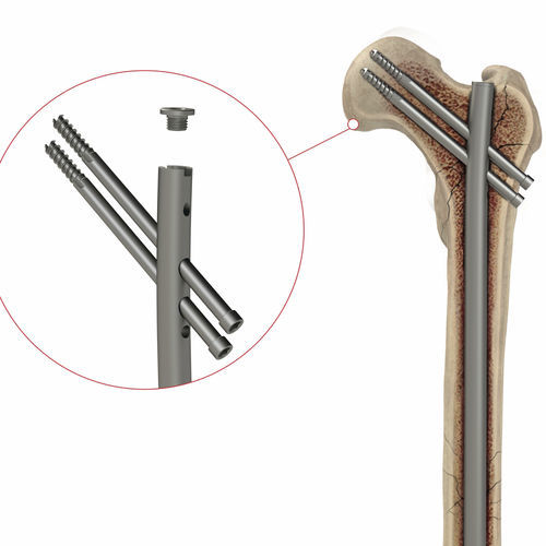Chiodo intramidollare per femore - 4T1-4001050 - Ases Orthopedics - fissazione prossimale