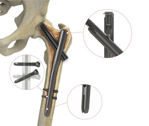 Chiodo intramidollare per femore - 4T1-40310170 - Ases Orthopedics - fissazione prossimale
