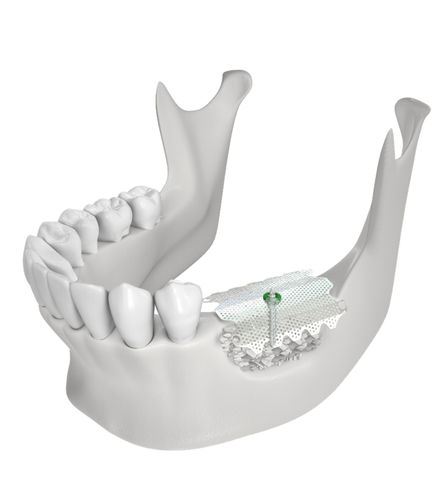 Materiale odontoiatrico in titanio - CTi-mem - Neobiotech - per ricostruzione dentale