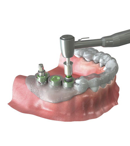 Sistema di navigazione chirurgica per chirurgia dentale - Neo NaviGuide - Neobiotech - ottico