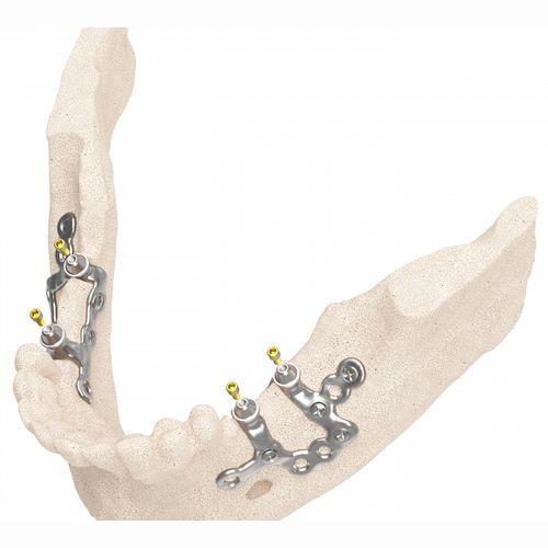Guida chirurgica odontoiatrica - IUXTA 3D - Biotec - BTK