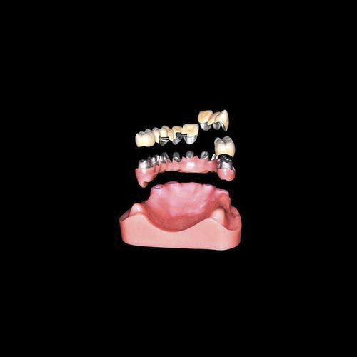 Impianto dentale cilindrico conico - Shenzhen Alcadent Co.Ltd Alcadent Dental Laboratory - in metallo / dritto / per laboratorio odontotecnico