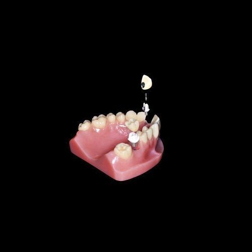 Pilastro dentale per impianto in titanio - Shenzhen Alcadent Co.Ltd Alcadent Dental Laboratory - in zircone / in PEEK / interno