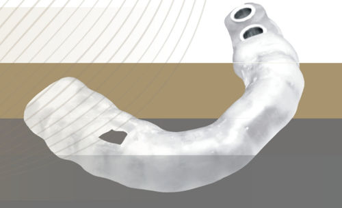 Guida chirurgica per implantologia dentale - Alliance Global Technology Co.,Ltd