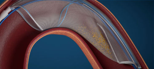 Sistema di protezione embolica aortico - FLOWer - Aorticlab