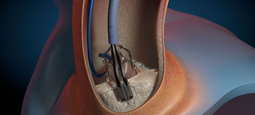 Catetere per aterectomia - GEMINI  - Aorticlab - aortico