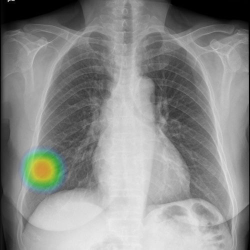 Software per radiografia - INSIGHT CXR - Lunit - medico / di rilevamento / di polmone
