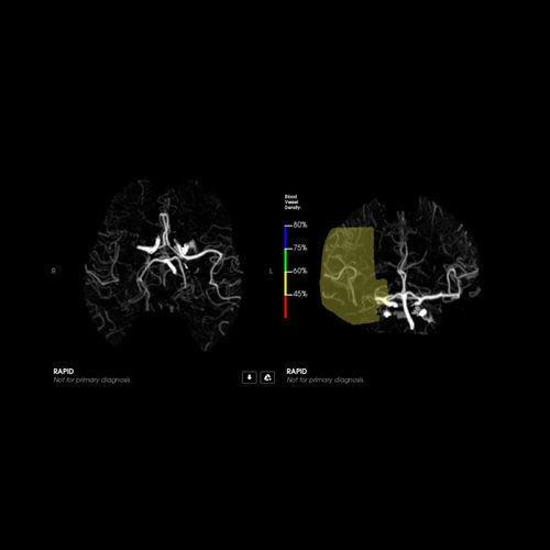 Software di trattamento - CTA - RapidAI - di acquisizione / medico / per tomografia computerizzata