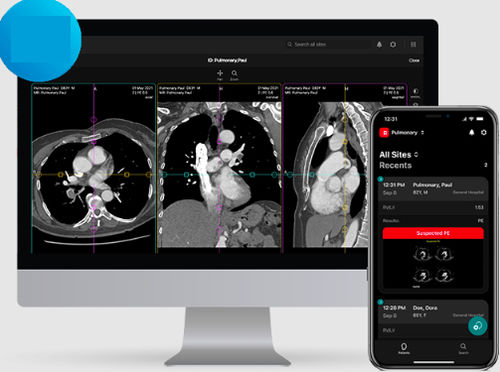 Software visualizzatore - PE - RapidAI - diagnostico / di trattamento / medico
