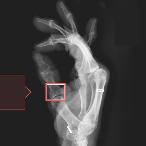 Software di diagnosi di fratture - RBfracture™ - Radiobotics - medico / di emergenza / per radiologia