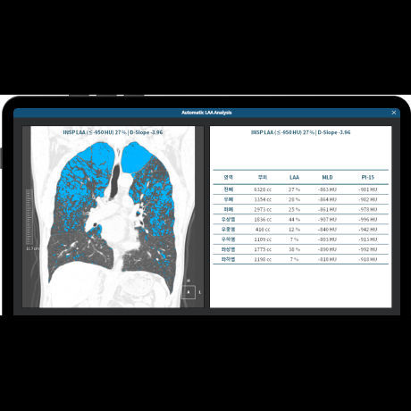 Software medico - LCS PLUS - Coreline - per tomografia computerizzata / di analisi / per screening del tumore del pomone