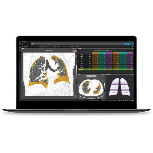 Software medico - ILA - Coreline - di analisi / per reportistica / di polmone