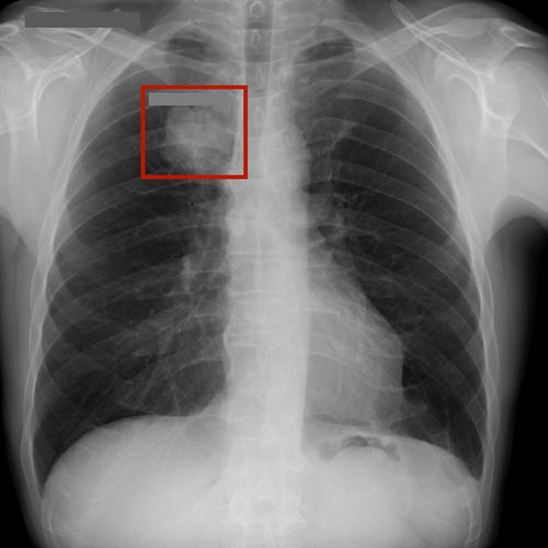 Software per radiologia - RAYVOLVE - AZmed - di analisi delle immagini / di petto / con intelligenza artificiale