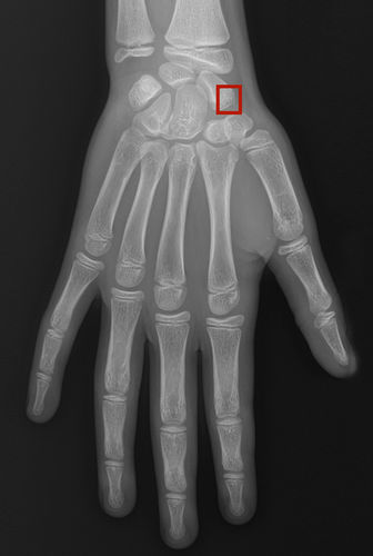 Software medico - Rayvolve - AZmed - per radiologia / di analisi delle immagini / di diagnosi di fratture