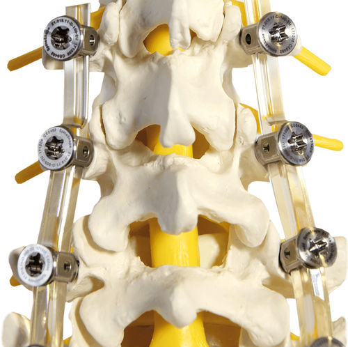 Sistema di osteosintesi lombare - SpineShape System IV - SpineSave - via posteriore / per adulti