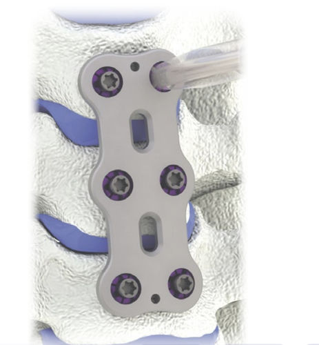 Placca per artrodesi per vertebra cervicale - HERO® - HumanTech Dental - 2 livelli
