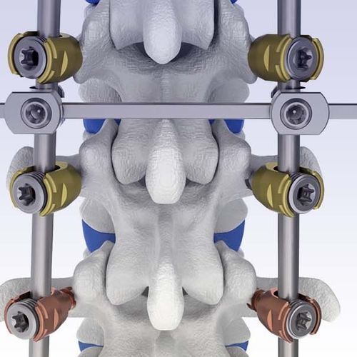 Sistema di osteosintesi toraco-lombare - VENUS® - HumanTech Dental - via posteriore / per adulti