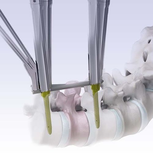 Sistema di posizionamento di viti peduncolari mininvasivo - VENUS®mini 2.0 - HumanTech Dental